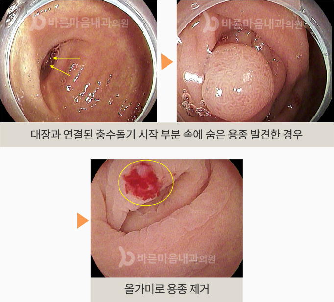 대장과 연결된 충수돌기 시작 부분 속에 숨은 용종 발견한 경우 > 대장과 연결된 충수돌기 시작 부분 속에 숨은 용종 발견한 경우