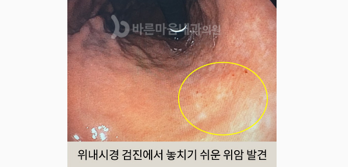 위내시경 검진에서 놓치기 쉬운 위암 발견