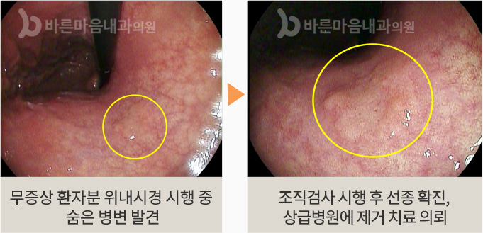 무증상 환자분 위내시경 시행 중 숨은 병변 발견 > 조직검사 시행 후 선종 확진, 상급병원에 제거 치료 의뢰