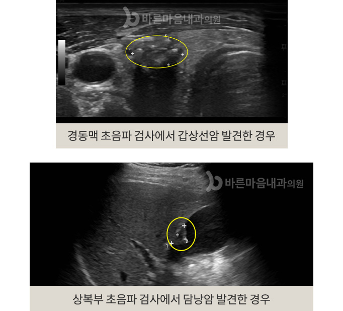 경동맥 초음파 검사에서 갑상선암 발견한 경우(위) / 상복부 초음파 검사에서 담낭암 발견한 경우(아래)