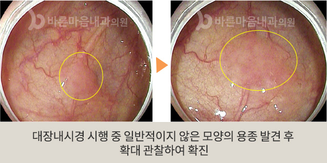 대장내시경 시행 중 일반적이지 않은 모양의 용종 발견 후 확대 관찰하여 확진