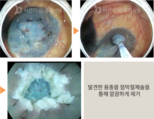 발견한 용종을 점막절제술을 통해 깔끔하게 제거