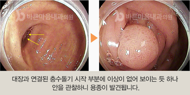 대장과 연결된 충수돌기 시작 부분에 이상이 없어 보이는 듯 하나 안을 관찰하니 용종이 발견됩니다.
