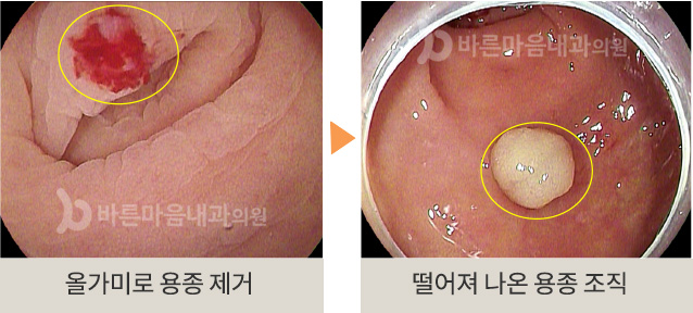 올가미로 용종 제거 > 떨어져 나온 용종 조직