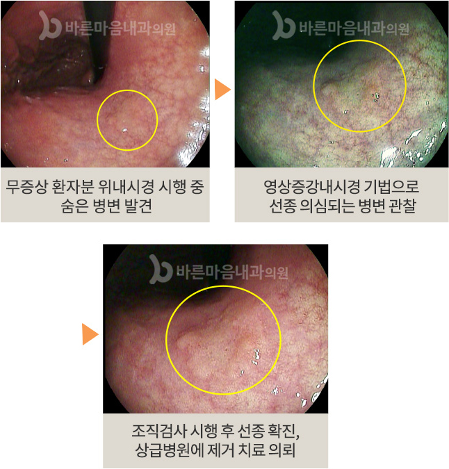 무증상 환자분 위내시경 시행 중 숨은 병변 발견 > 영상증강내시경 기법으로 선종 의심되는 병변 관찰 > 조직검사 시행 후 선종 확진, 상급병원에 제거 치료 의뢰