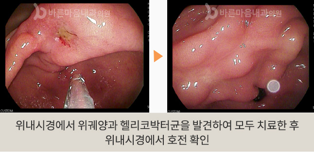 위내시경에서 위궤양과 헬리코박터균을 발견하여 모두 치료한 후 위내시경에서 호전 확인